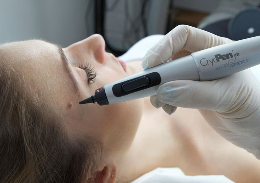 Skin Tag Removal Treatment