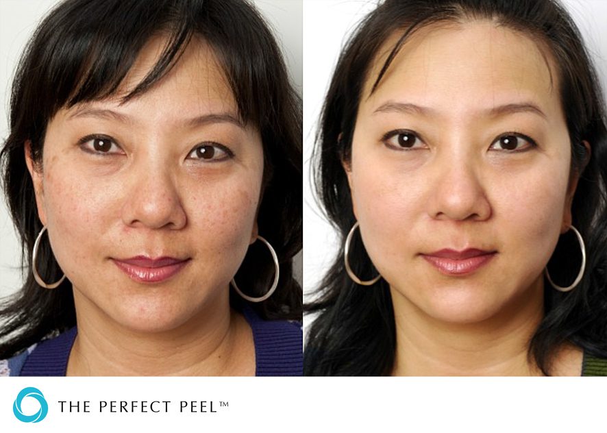 The Perfect Peel before and after