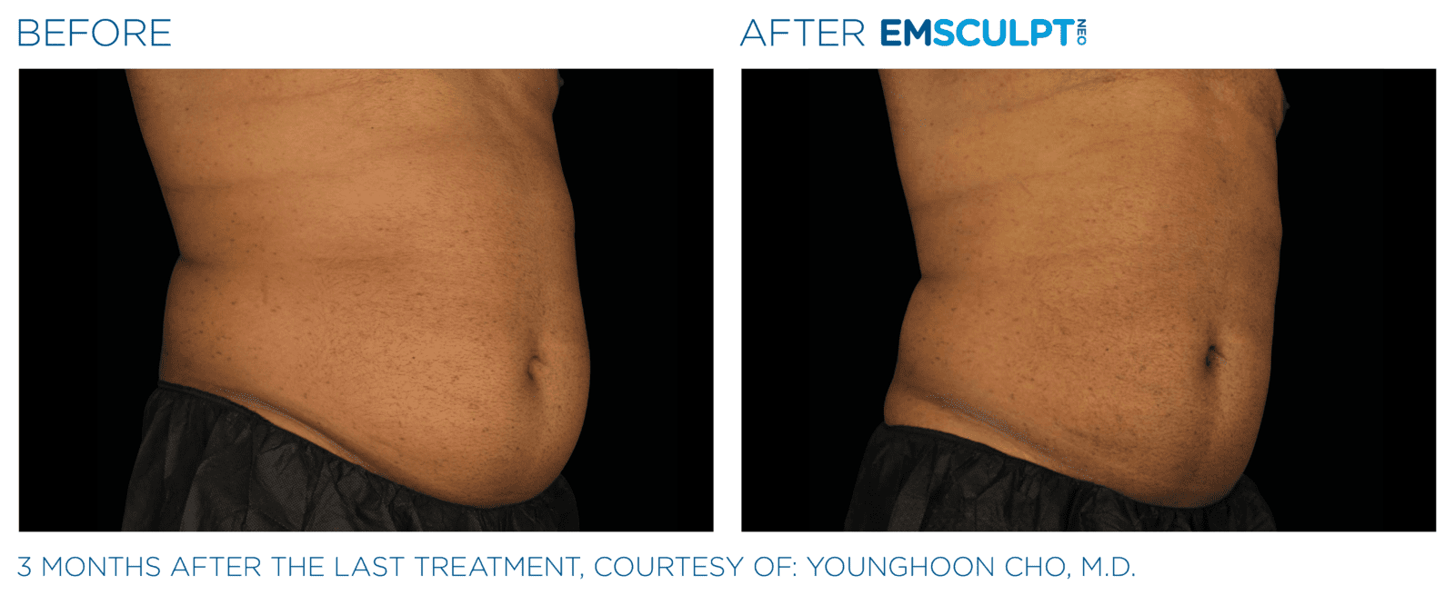 Emsculpt_Neo_PIC_Ba-card-male-lateral-abdomen-149_ENUS100