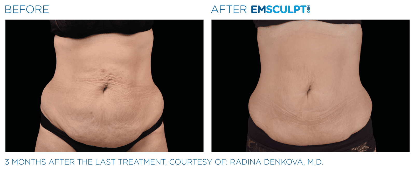 Emsculpt_neo_PIC_Ba-card-female-abdomen-009_EN100